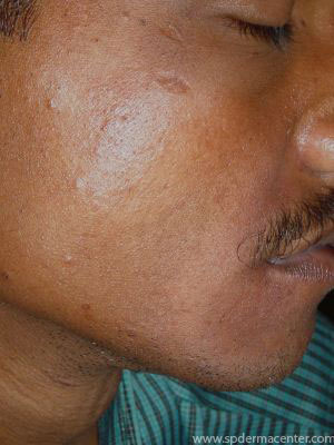 PIH-After